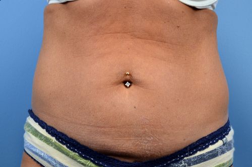 Before And After Patient Image