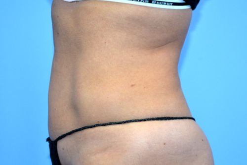 Before And After Patient Image