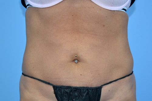 Before And After Patient Image