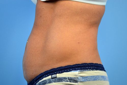 Before And After Patient Image