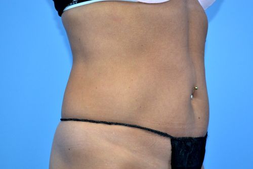 Before And After Patient Image