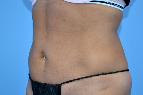 Before And After Patient Image