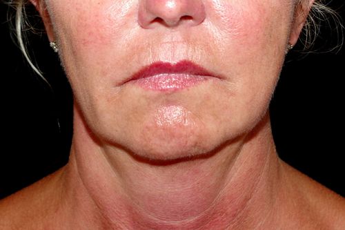 Before And After Patient Image