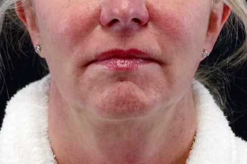 Before And After Patient Image