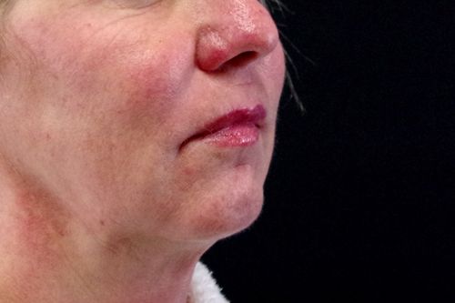 Before And After Patient Image