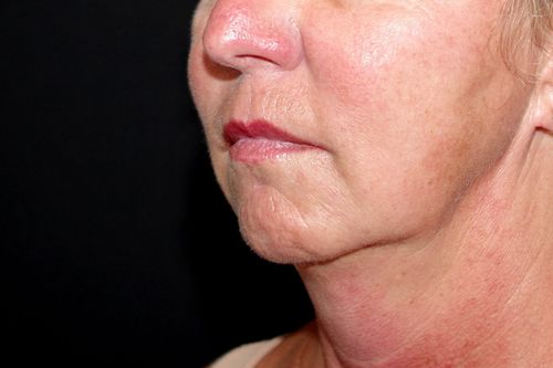 Before And After Patient Image