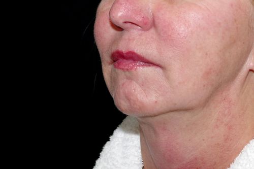 Before And After Patient Image