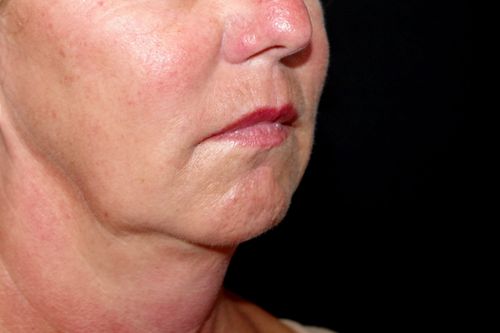 Before And After Patient Image