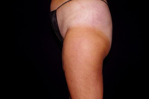 Before And After Patient Image