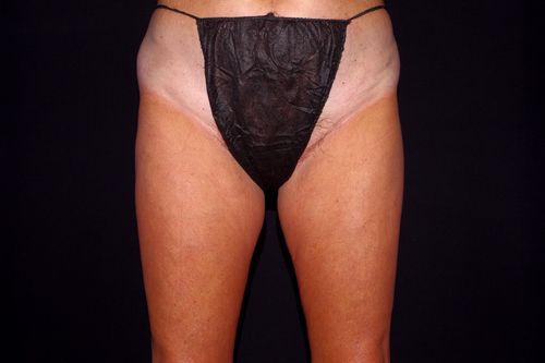 Before And After Patient Image