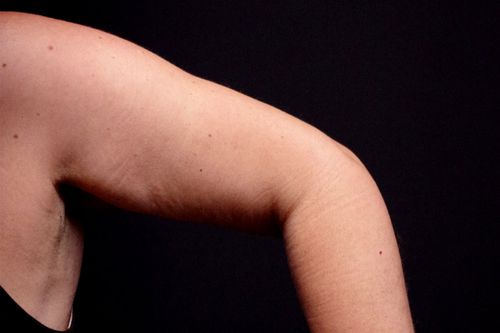 Before And After Patient Image