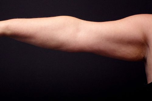 Before And After Patient Image