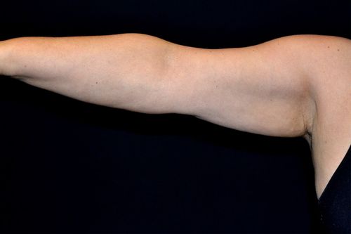 Before And After Patient Image