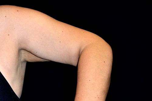 Before And After Patient Image