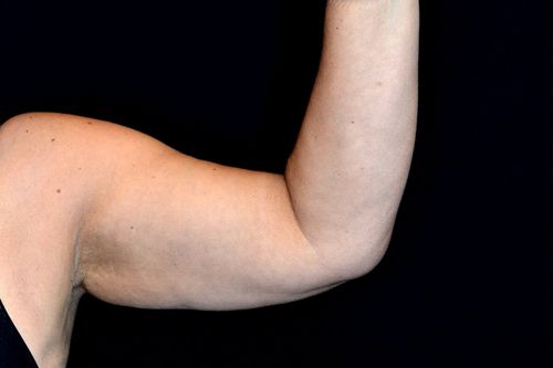 Before And After Patient Image