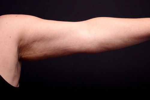 Before And After Patient Image