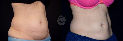 Before And After Patient Image