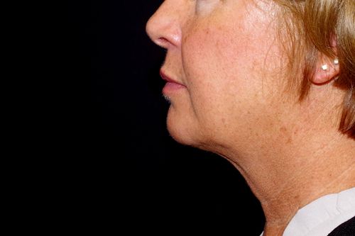 Before And After Patient Image