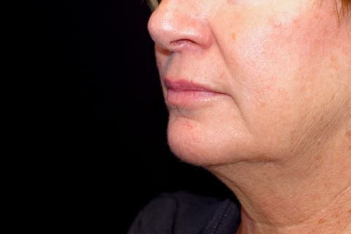 Before And After Patient Image