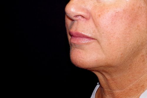 Before And After Patient Image