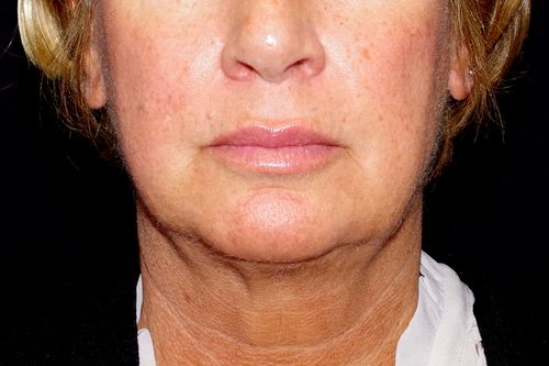 Before And After Patient Image