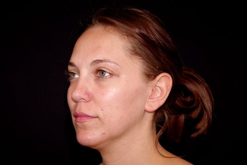 Before And After Patient Image