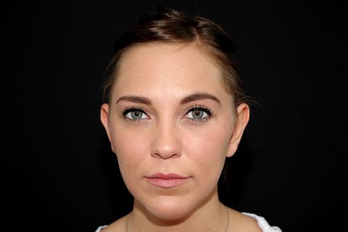 Before And After Patient Image