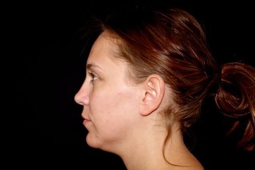 Before And After Patient Image