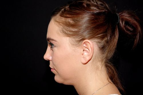 Before And After Patient Image