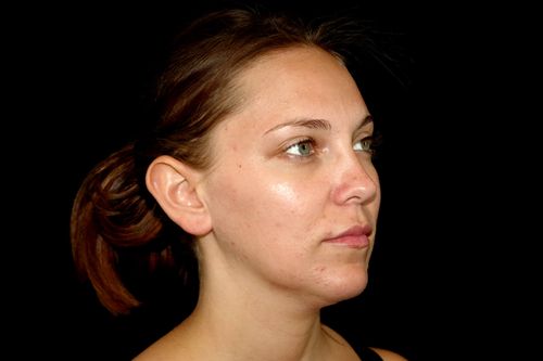 Before And After Patient Image