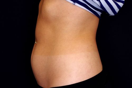 Before And After Patient Image