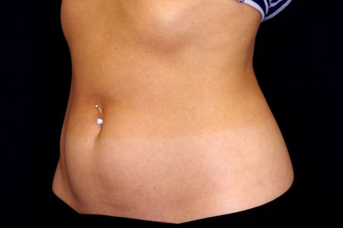 Before And After Patient Image