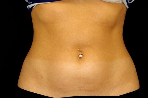 Before And After Patient Image