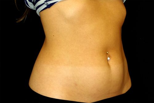 Before And After Patient Image