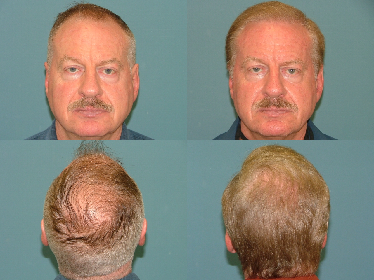 Hair Restoration Before and After