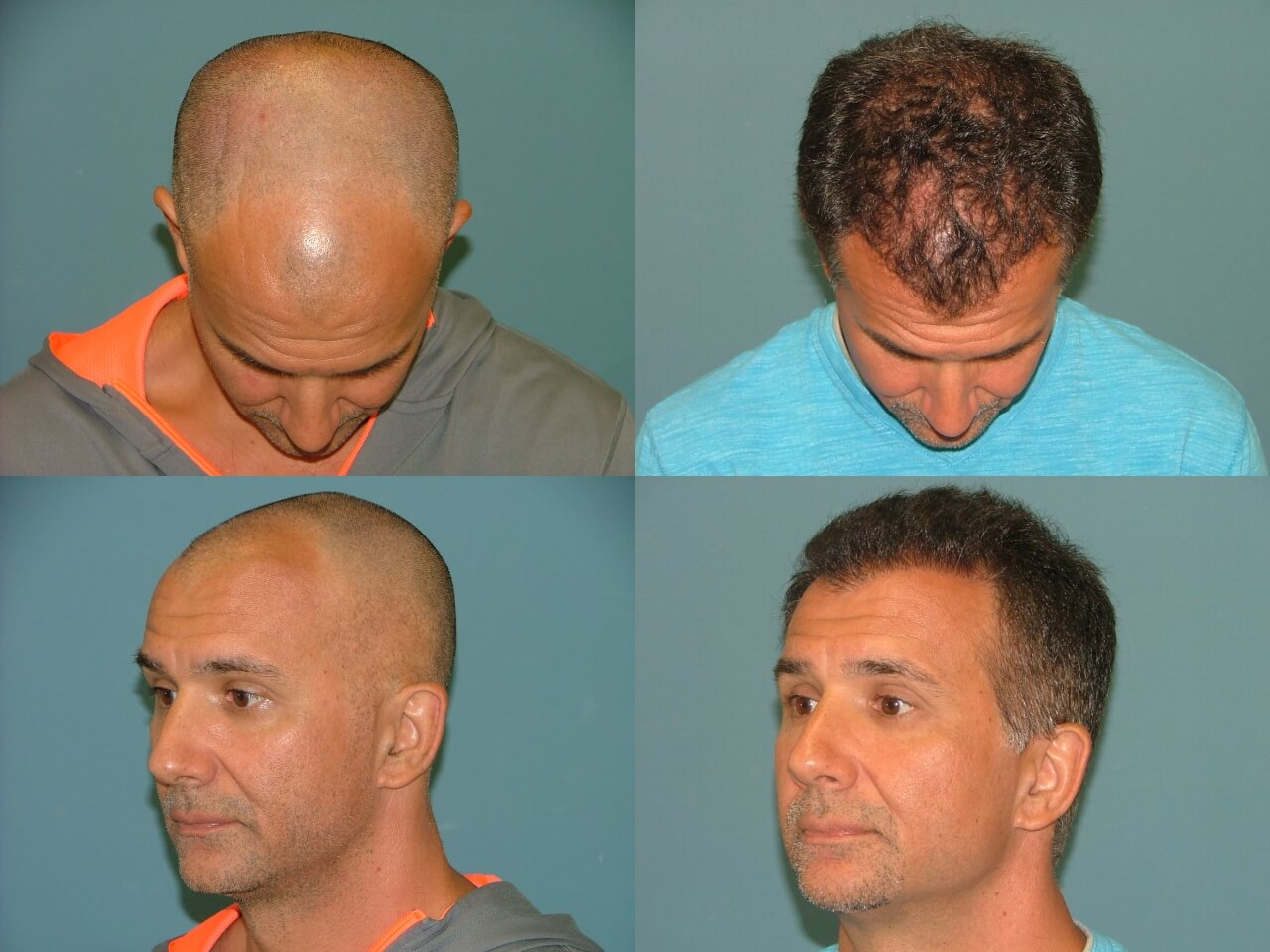Hair Restoration Before and After