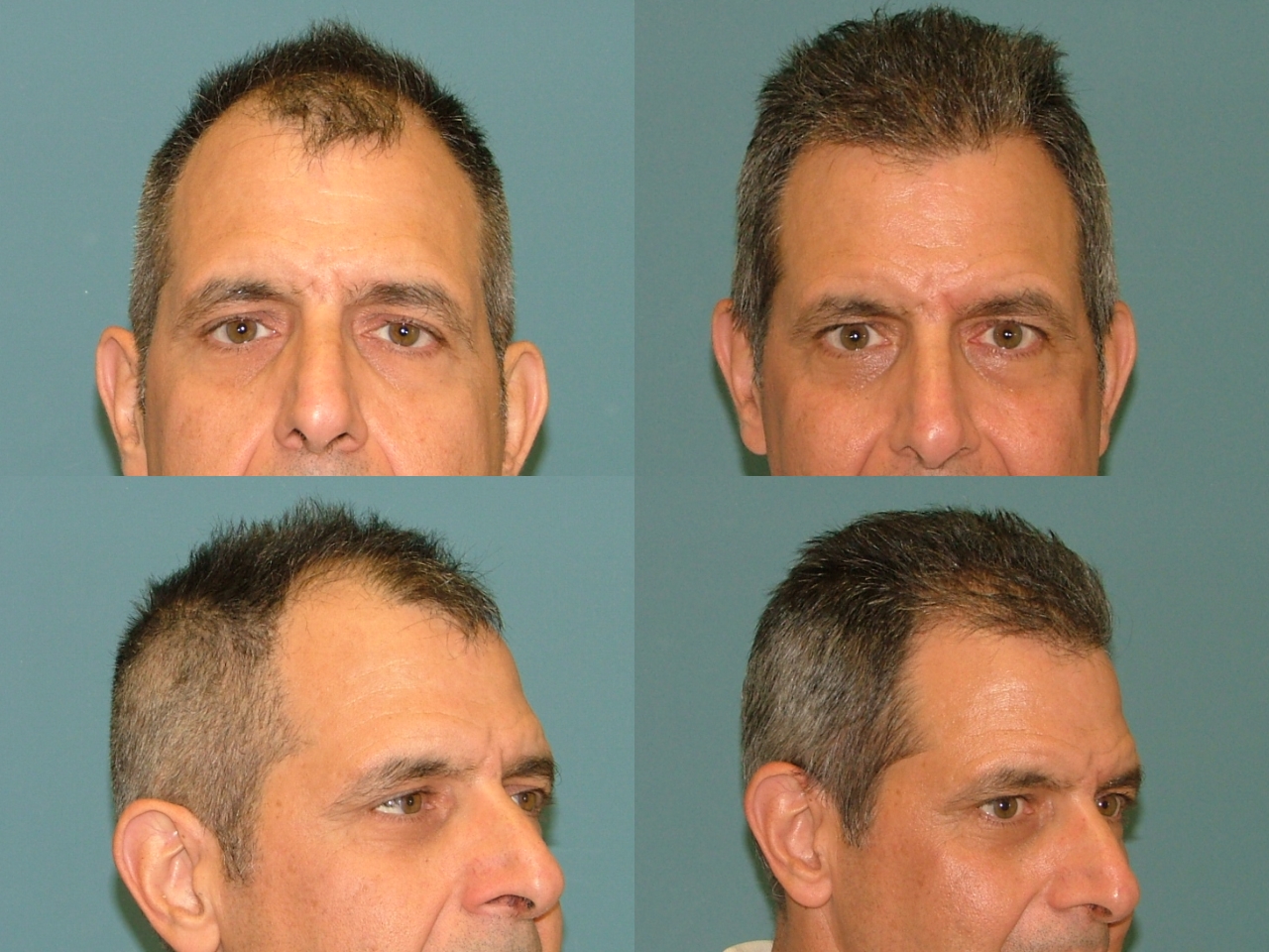 Hair Restoration Before and After