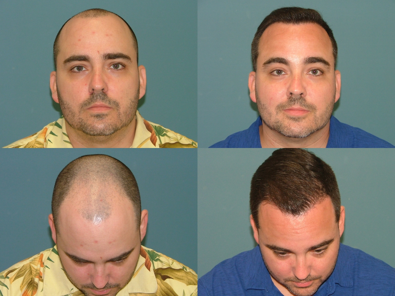 Hair Restoration Before and After