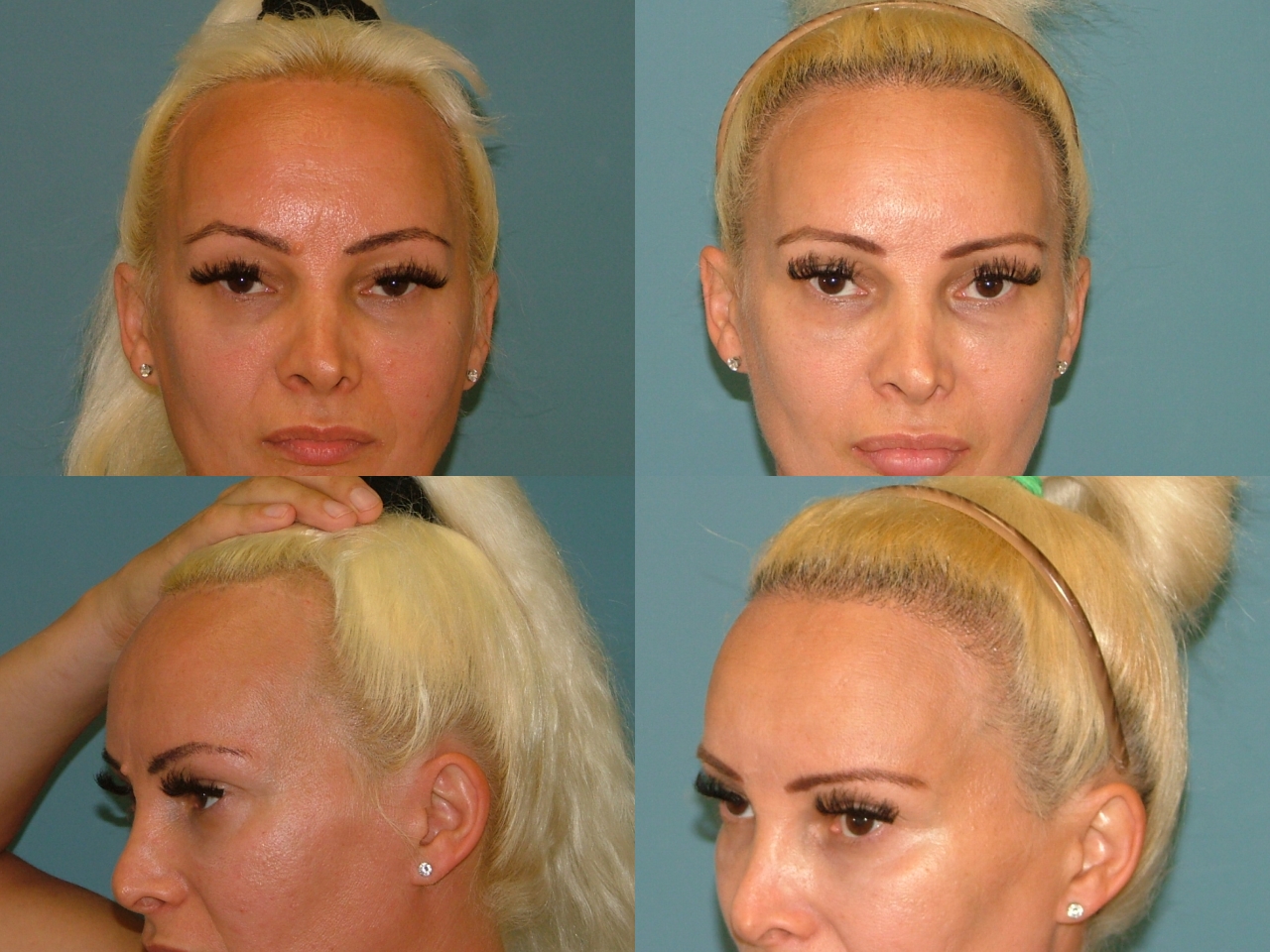 Hair Restoration Before and After