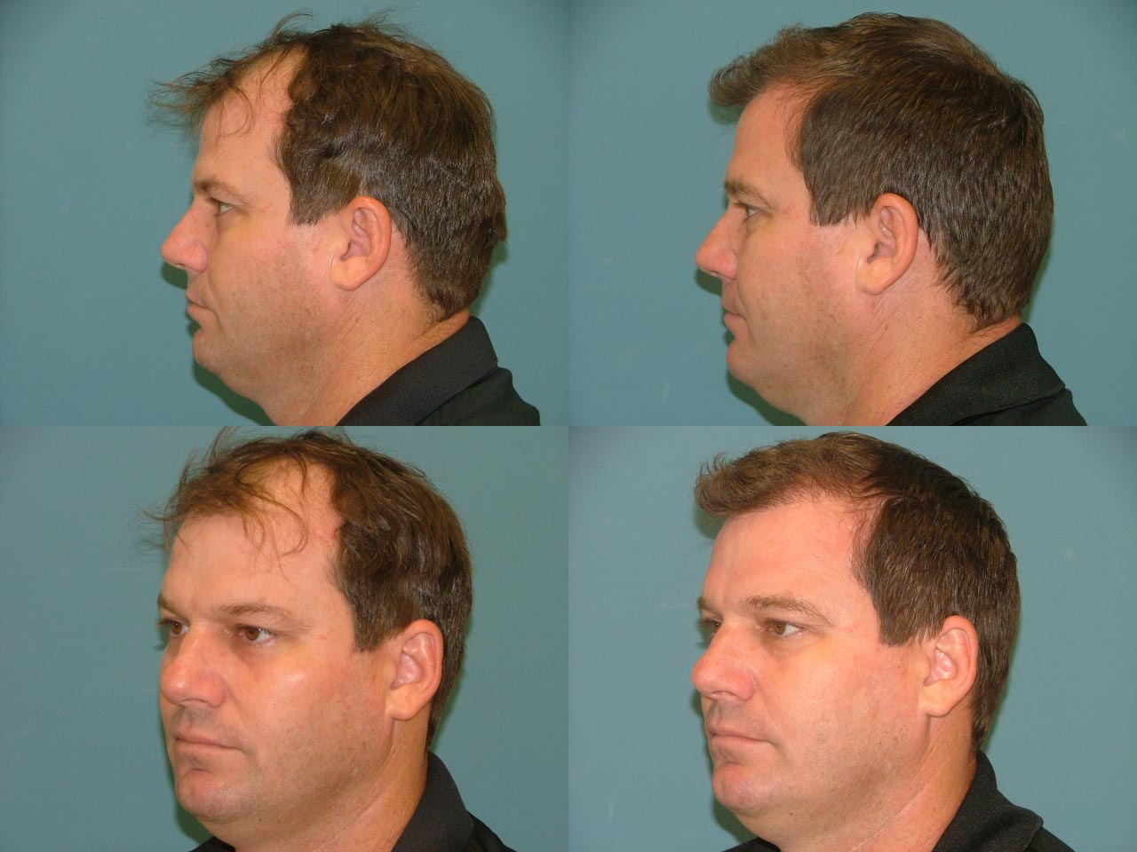 Hair Restoration Before and After