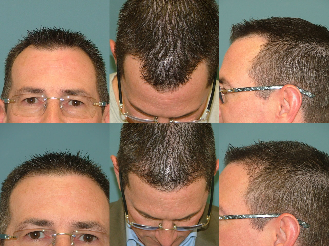 Hair Restoration Before and After