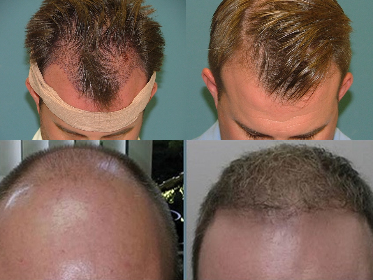 Hair Restoration Before and After