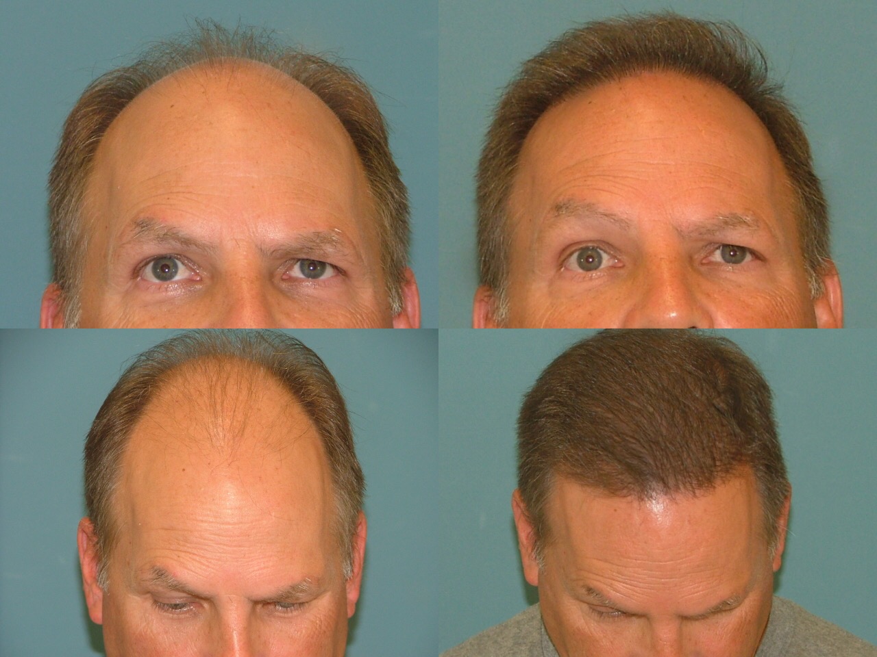 Hair Restoration Before and After