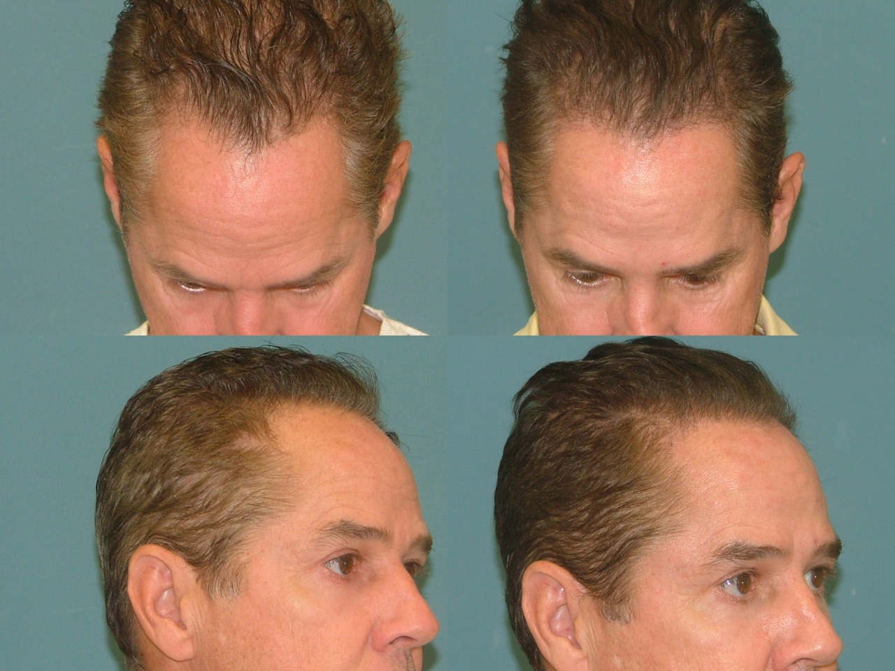 Hair Restoration Before and After