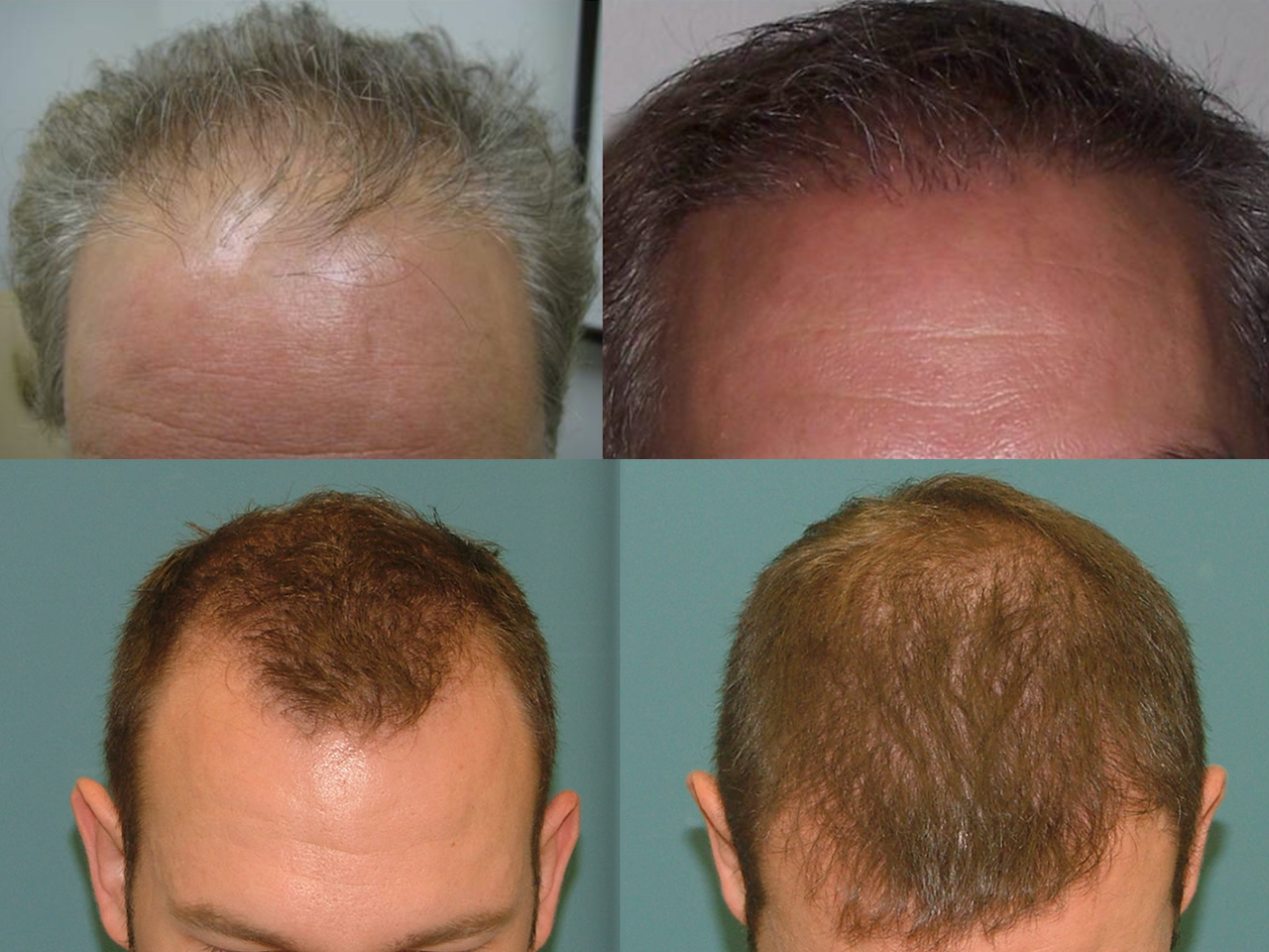 Hair Restoration Before and After