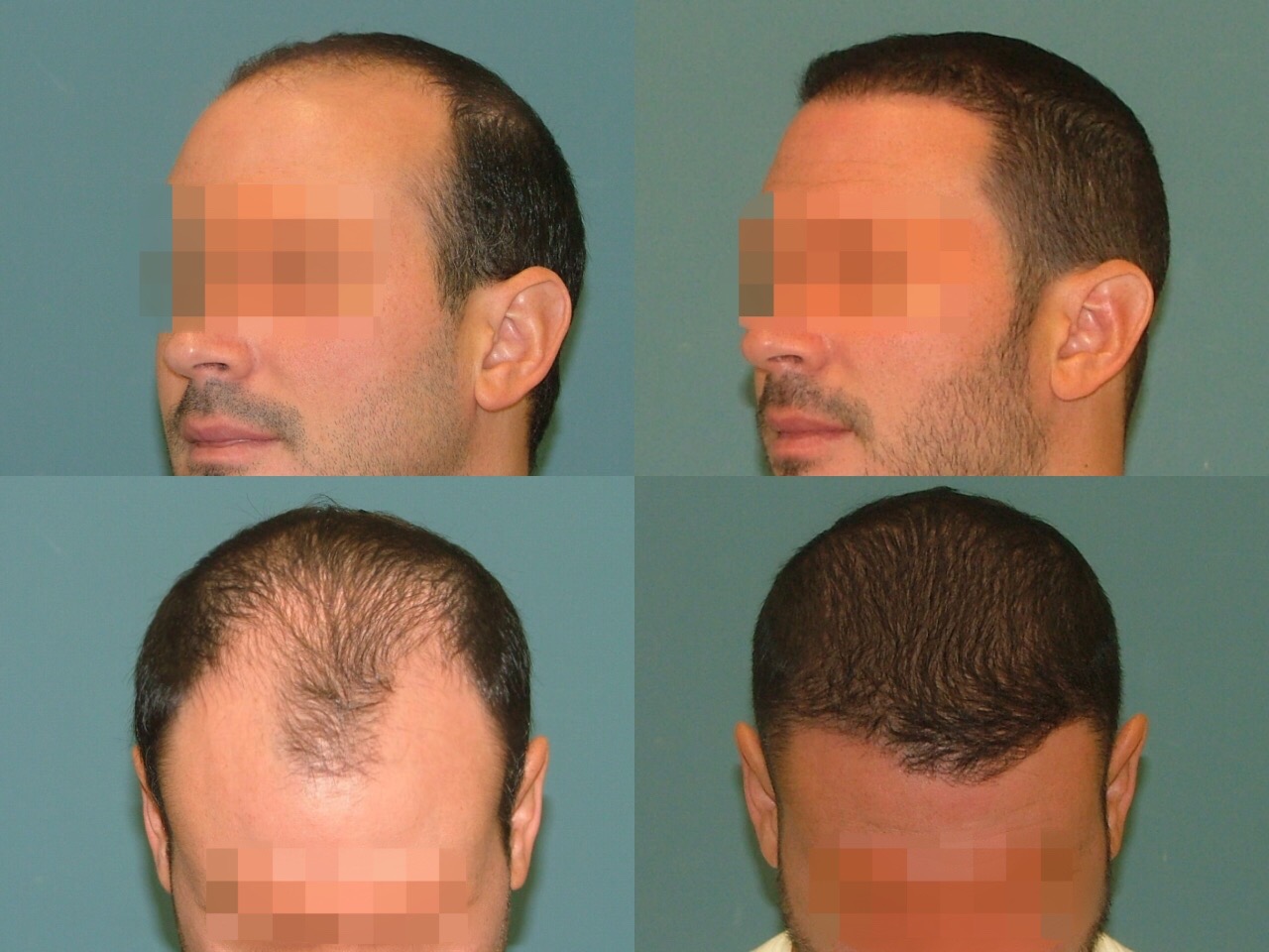 Hair Restoration Before and After