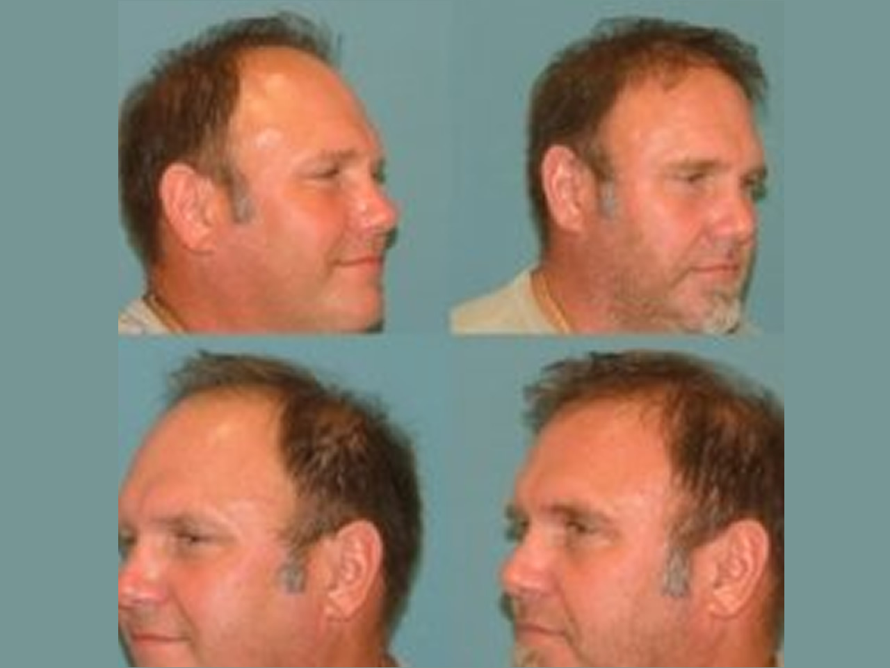 Hair Restoration Before and After