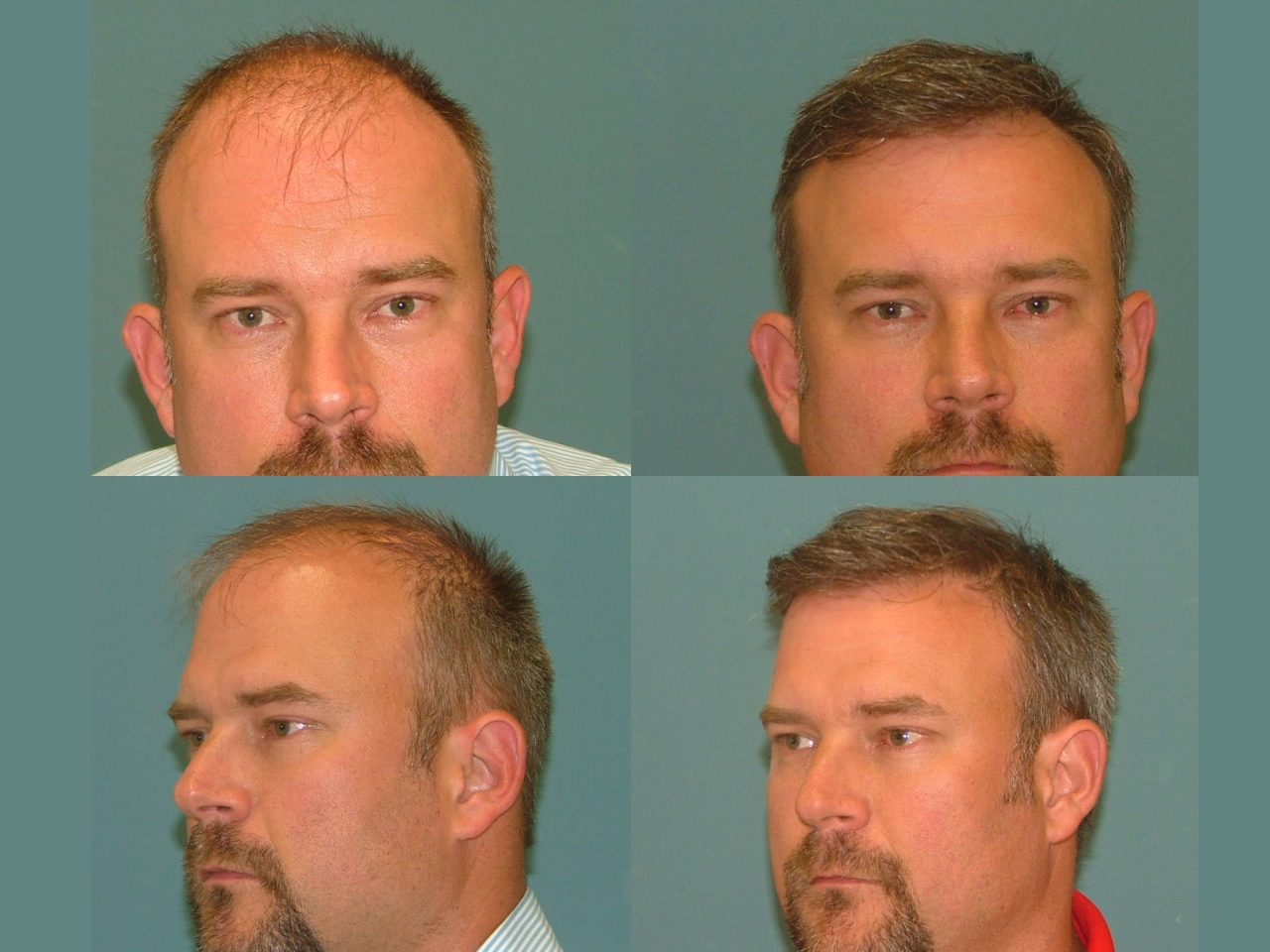 Hair Restoration Before and After