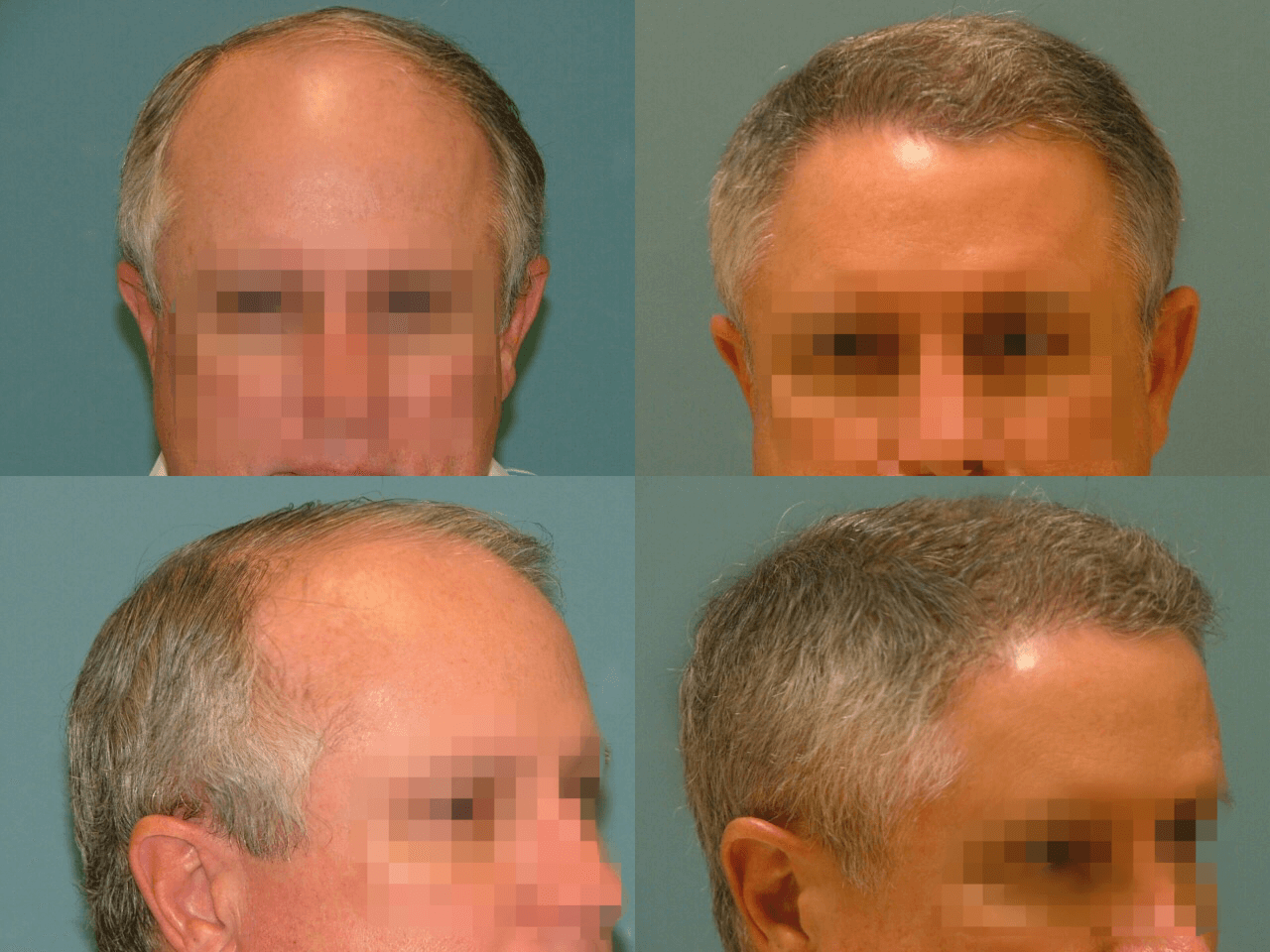 Hair Restoration Before and After