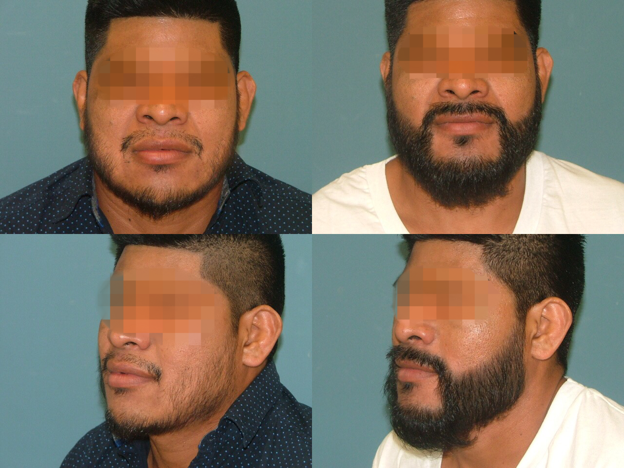 Hair Restoration Before and After